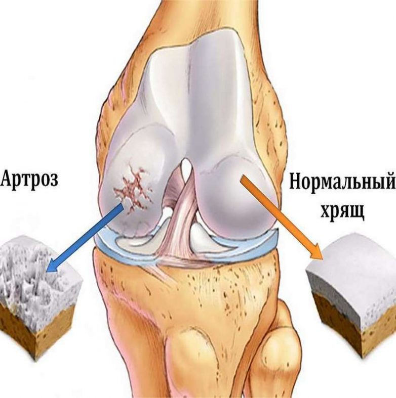 Лечебная гимнастика при артрозе