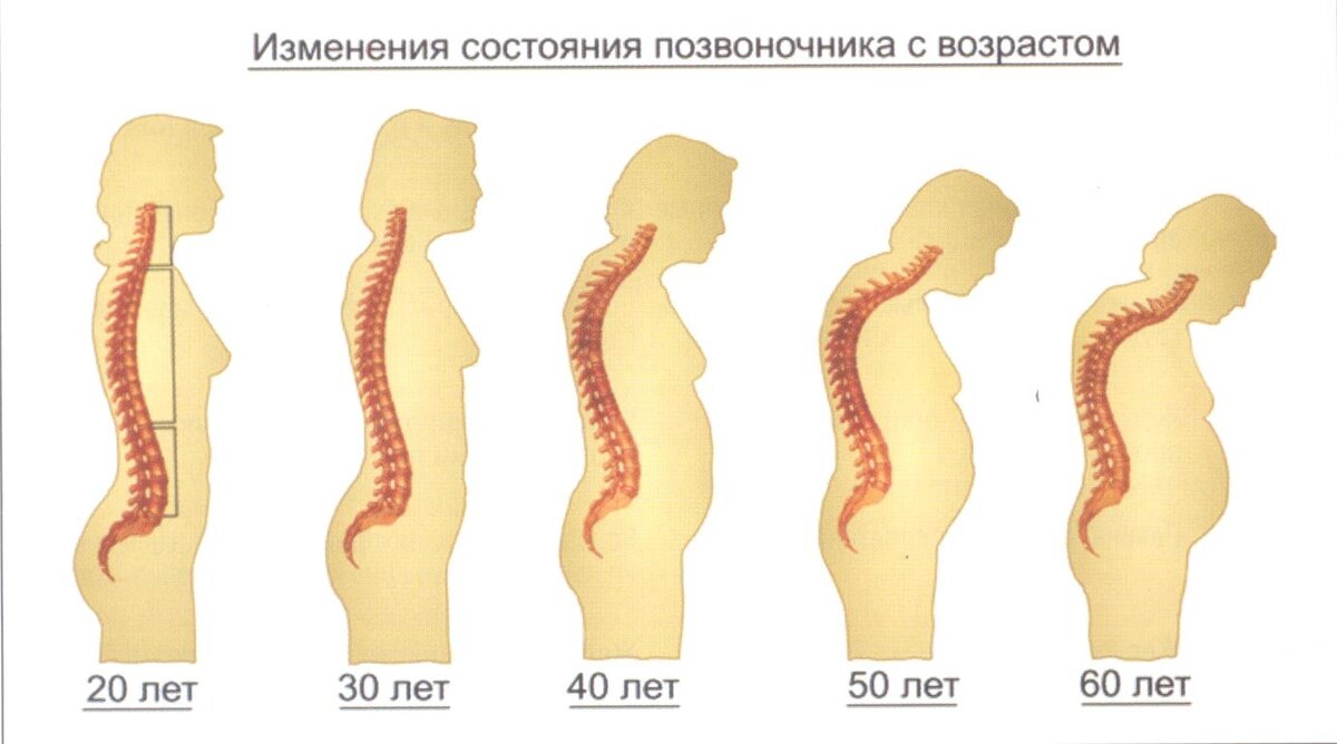 «Осевший» позвоночник — скрытая причина всех ваших болезней